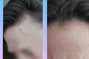 Hautbild Vorher-Nacher bei Behandlung mit Rhodiola Crenulata