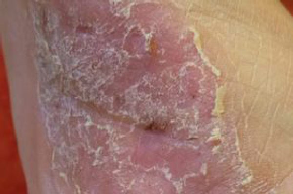 Vitiligo, die Weißfleckenkrankheit. Durch Rhodiola Crenulata Therapie setzt die Repigmentierung ein.